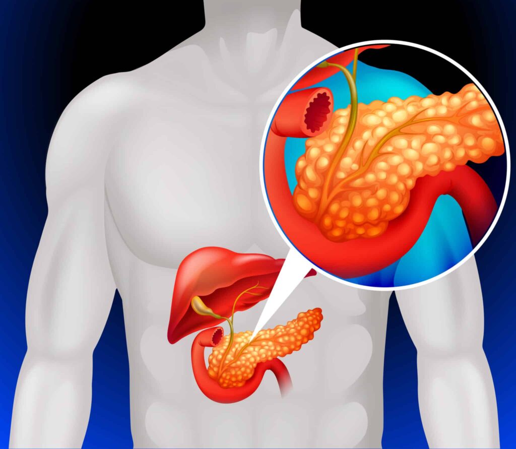 diabetes tipo 3c